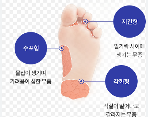 무좀과 발톱 꾸준한 관리