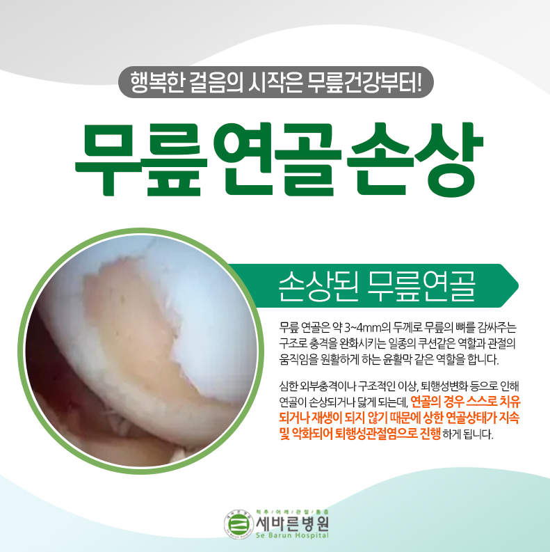  무릎연골수술 말고 다른 치료방법은?
