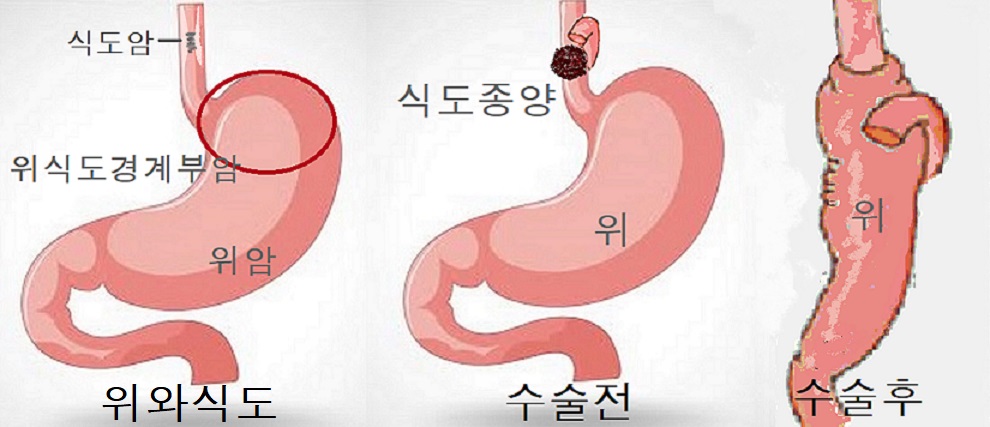  독한술을 마시나요? 식도암. 식도암 증상.식도암 검사.
