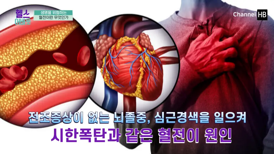 혈전용해제 나토키나제