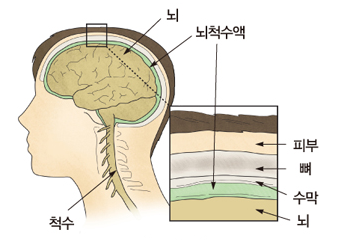  수막염 증상 원인 예방법까지 알아보자