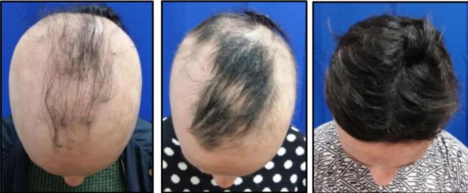 희소식! &quot;획기적 모발 치료제 나왔다&quot; 미 콘서트 파마슈티컬스 Experimental pill prompts some to regrow a nearly full head of hair