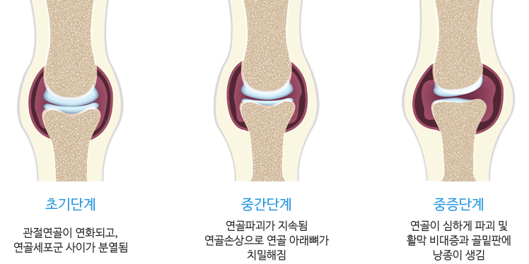 무릎 관절1