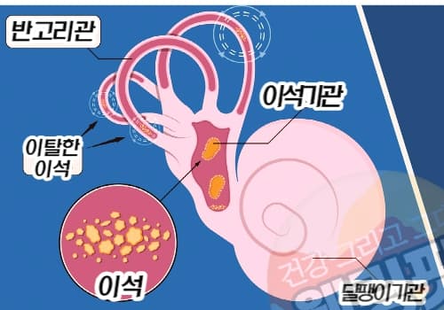 이석증은-전정기관에서-이탈한-이석에-의해-발생합니다.