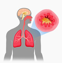  급성 기관지염(Acute Bronchitis) 간호