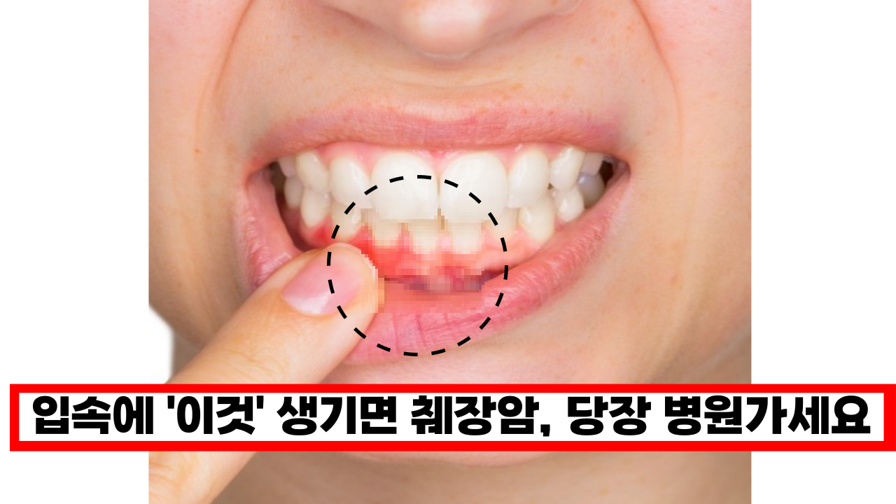  '사람들이 잘 모르는 췌장암 증상' 입속에 이것 생기면 췌장암 신호, 빨리 병원 가세요.