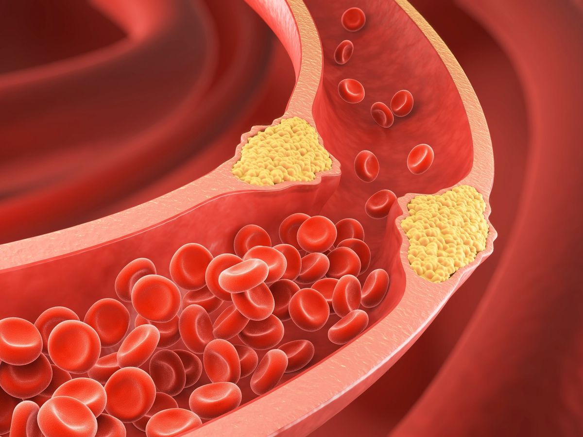 고지혈증 이미지