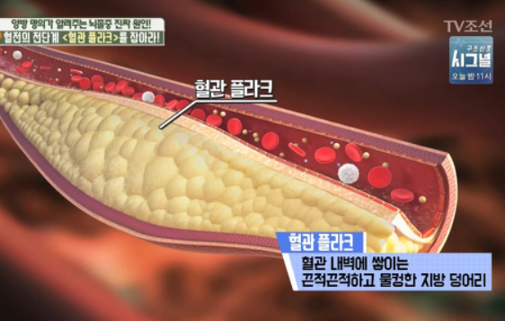 고지혈증
