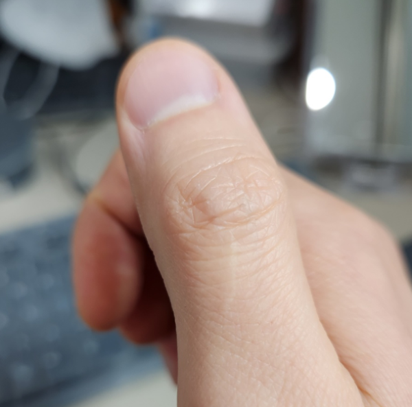 엄지손가락-찢어짐-완치