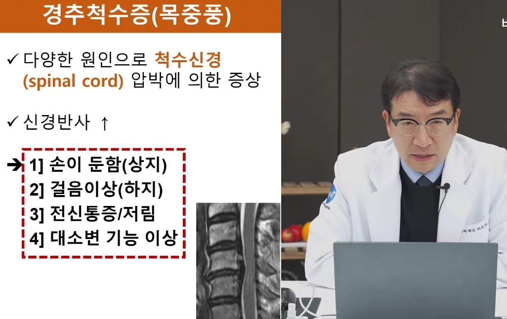 경추척수증-목중풍-원인