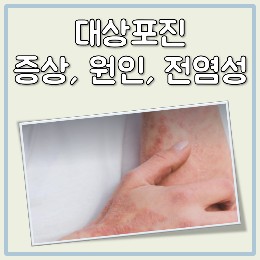 대상포진 대표 이미지