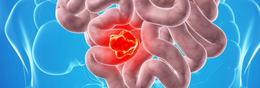 대장암 초기증세2