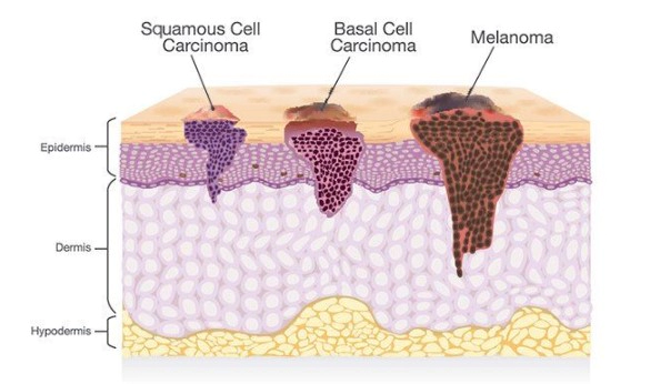 피부암 종류별 초기증상 10가지