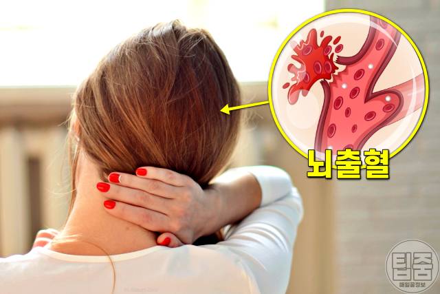 중풍 전조증상,중풍 증상,뒷목이 뻣뻣하고 두통,팁줌