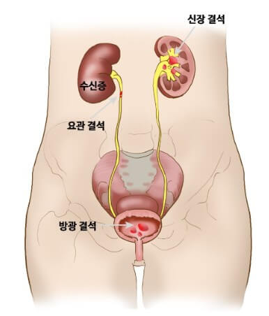 요로결석의 위치별 설명