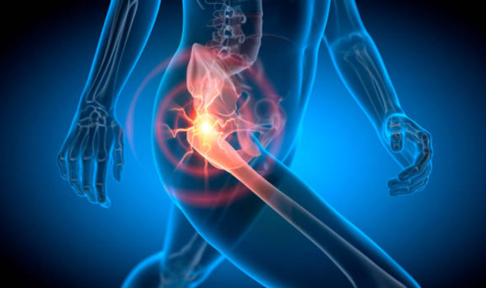 고관절 통증과 관련된 사진