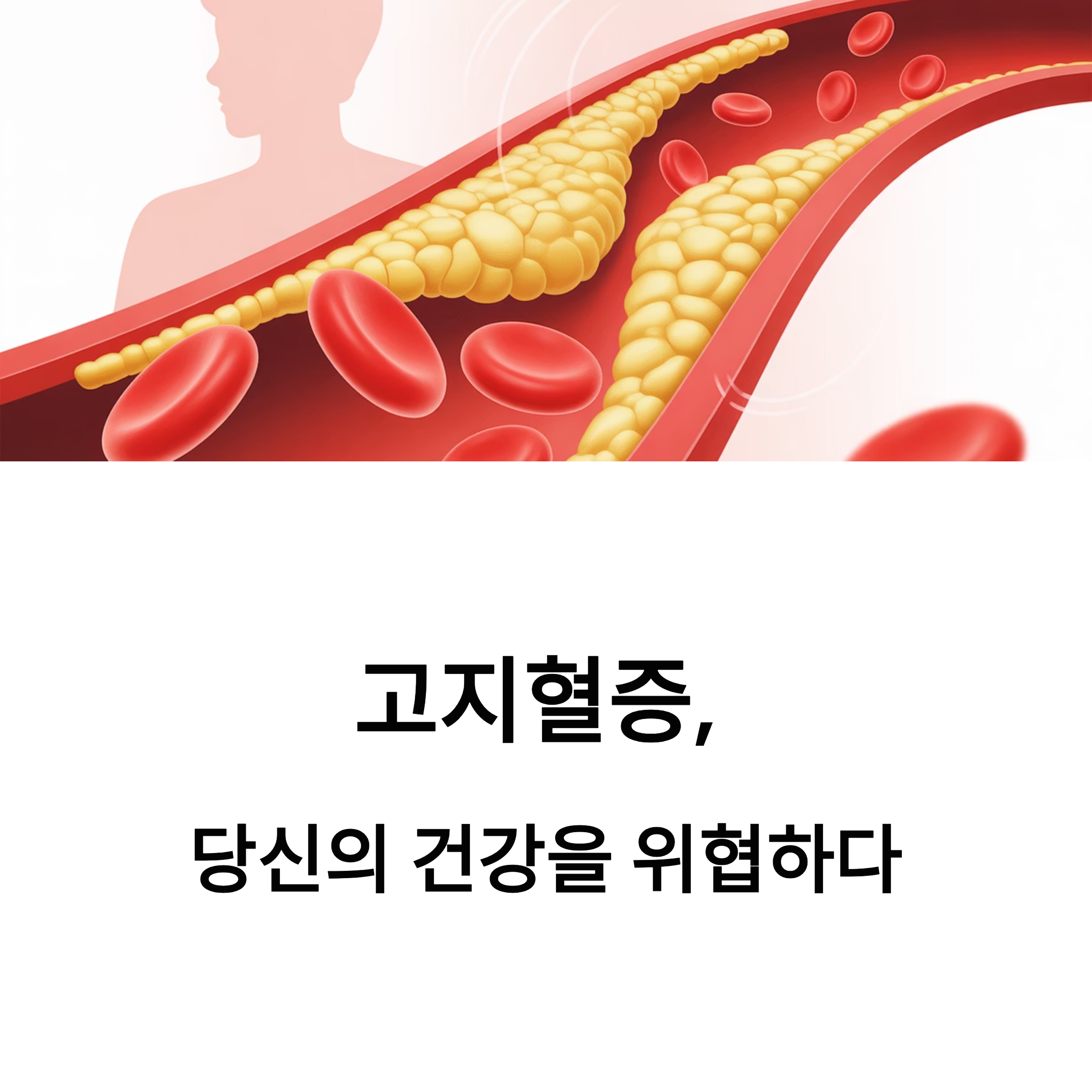 고지혈증