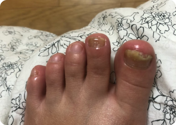 발톱 무좀 18주차