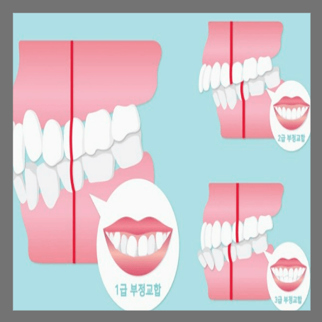 부정교합