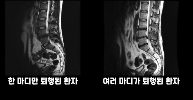 허리디스크 증상