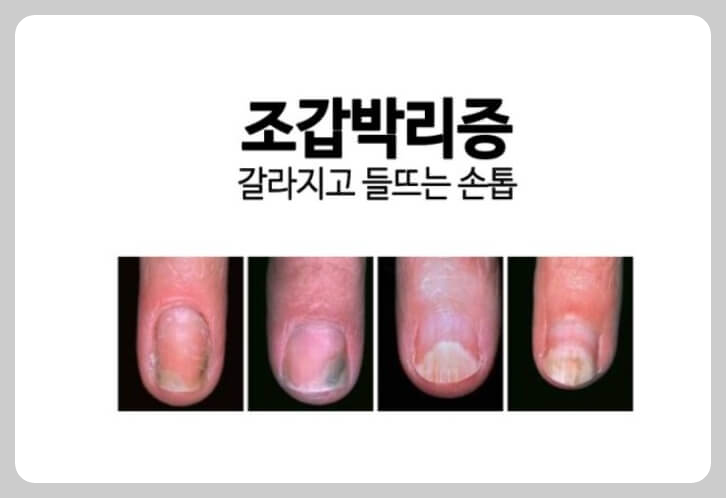 조갑박리증