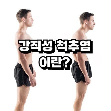 강직성 척추염