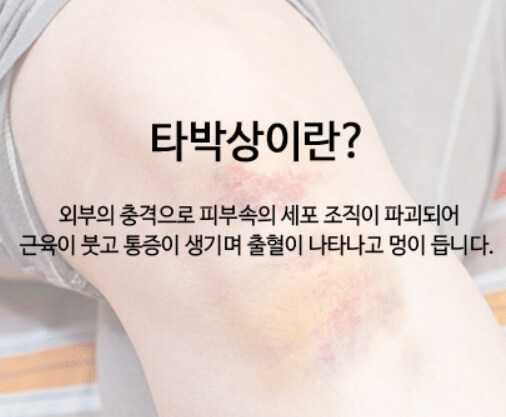 타박상 빨리 낫는법 - 타박상이란?
