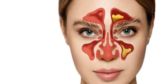 비염 증상&amp;#44; 뿌리를 뽑으려면&amp;#44; 치료방법 총정리 (2024ver)