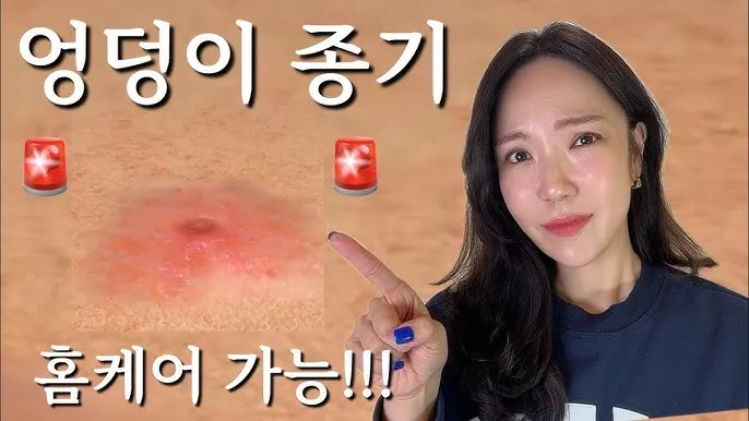 엉덩이 종기가 생기는 이유 왜 생기고 어떻게 관리할까요 완벽 가이드_1