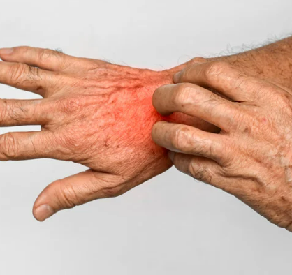 고양이 링웜 증상, 원인, 치료, 예방 총정리 원형탈모 무슨일?