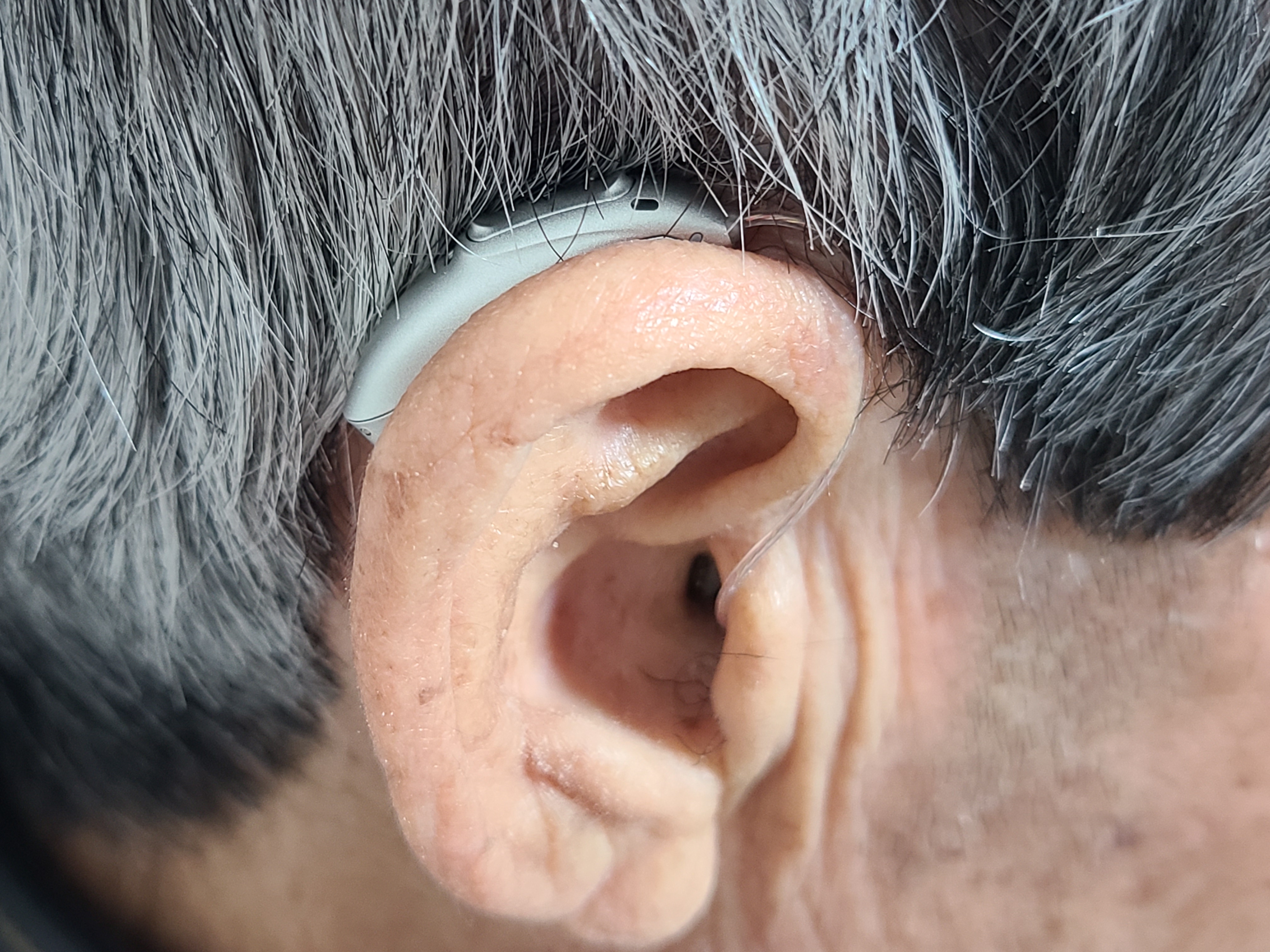 포낙 보청기 착용사진