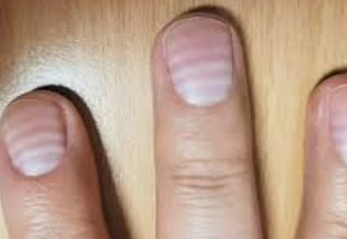 질병 : 손톱 세로줄을 유발하는 건강 이상 신호