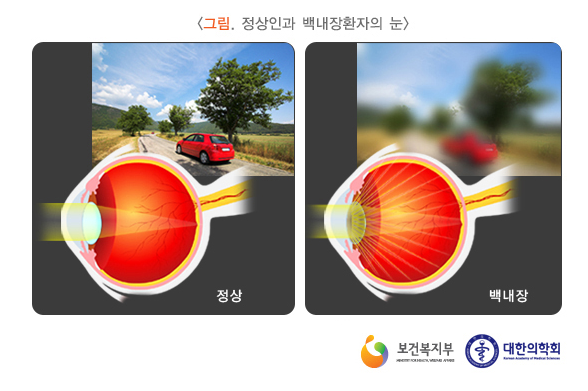 정상인과 백내장 환자의 차이