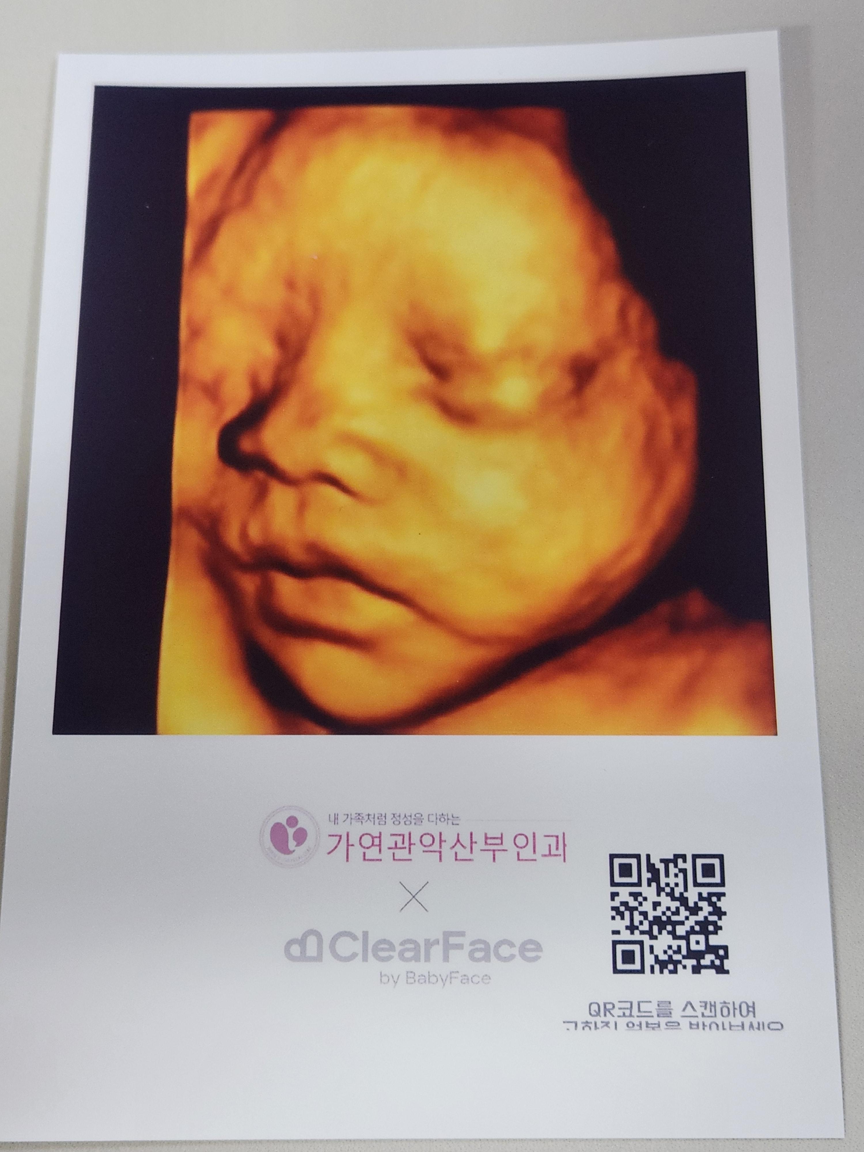 클리어페이스 입체초음파