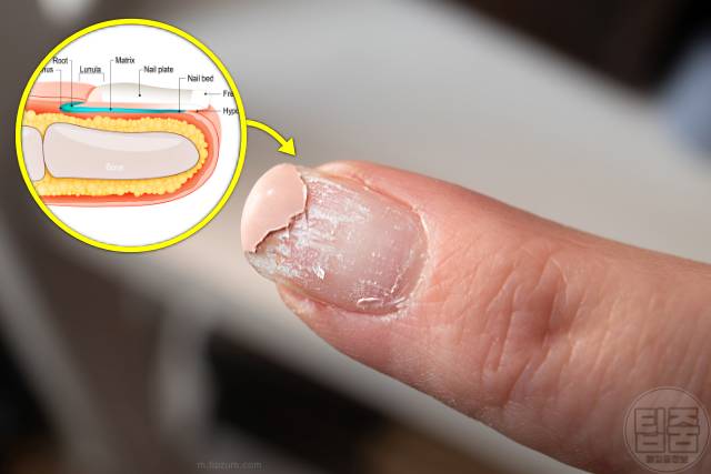 손톱 하얀 반점 손톱흰반점 손톱흰색가로줄 원인 네일