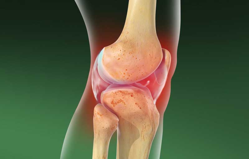 류머티스 관절염 관련 이미지