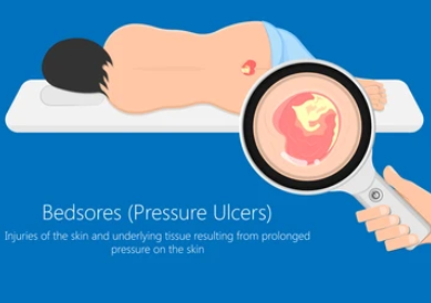 욕창 단계 치료 방법