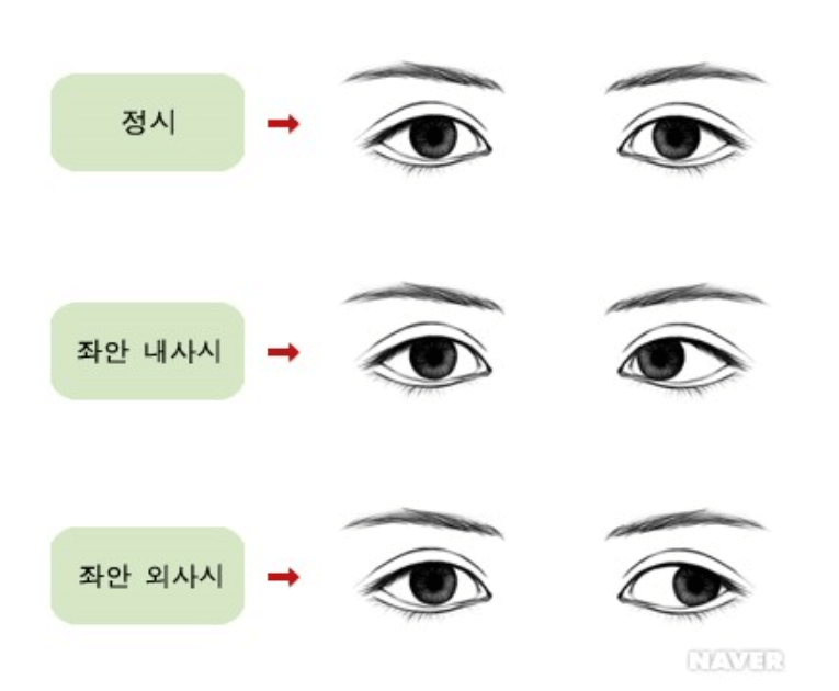 사시종류