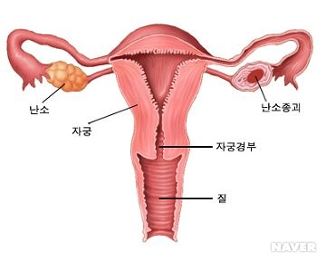 난소낭종