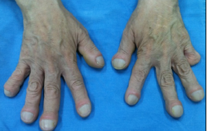 경피골막증 원인 분석 및 치료방법2