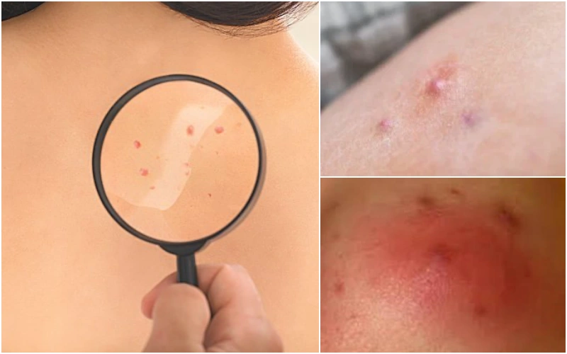 화농성 한선염의 진단 방법