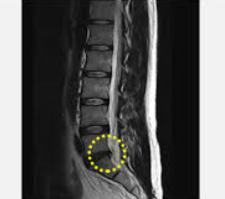 허리디스크 증상