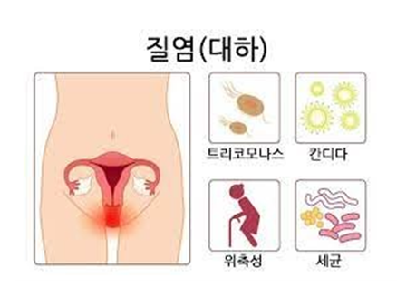 칸디다 질염 유산균5