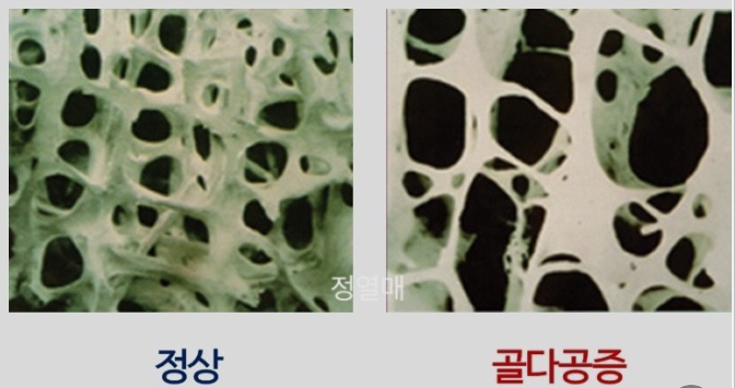 골다공증 환자의 뼈사진