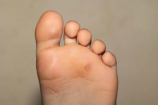 티눈 통증 참지 마세요! 부산에서 티눈 잘 빼주는 병원 찾는 법?