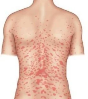 장미색비강진의 특징인 2차 발진이 등에 '크리스마스 트리' 형태로 분포된 것을 보여주는 다이어그램.