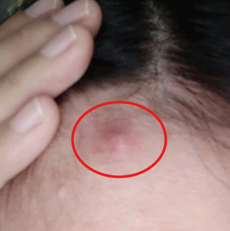 피지낭종 질병코드 실비보험