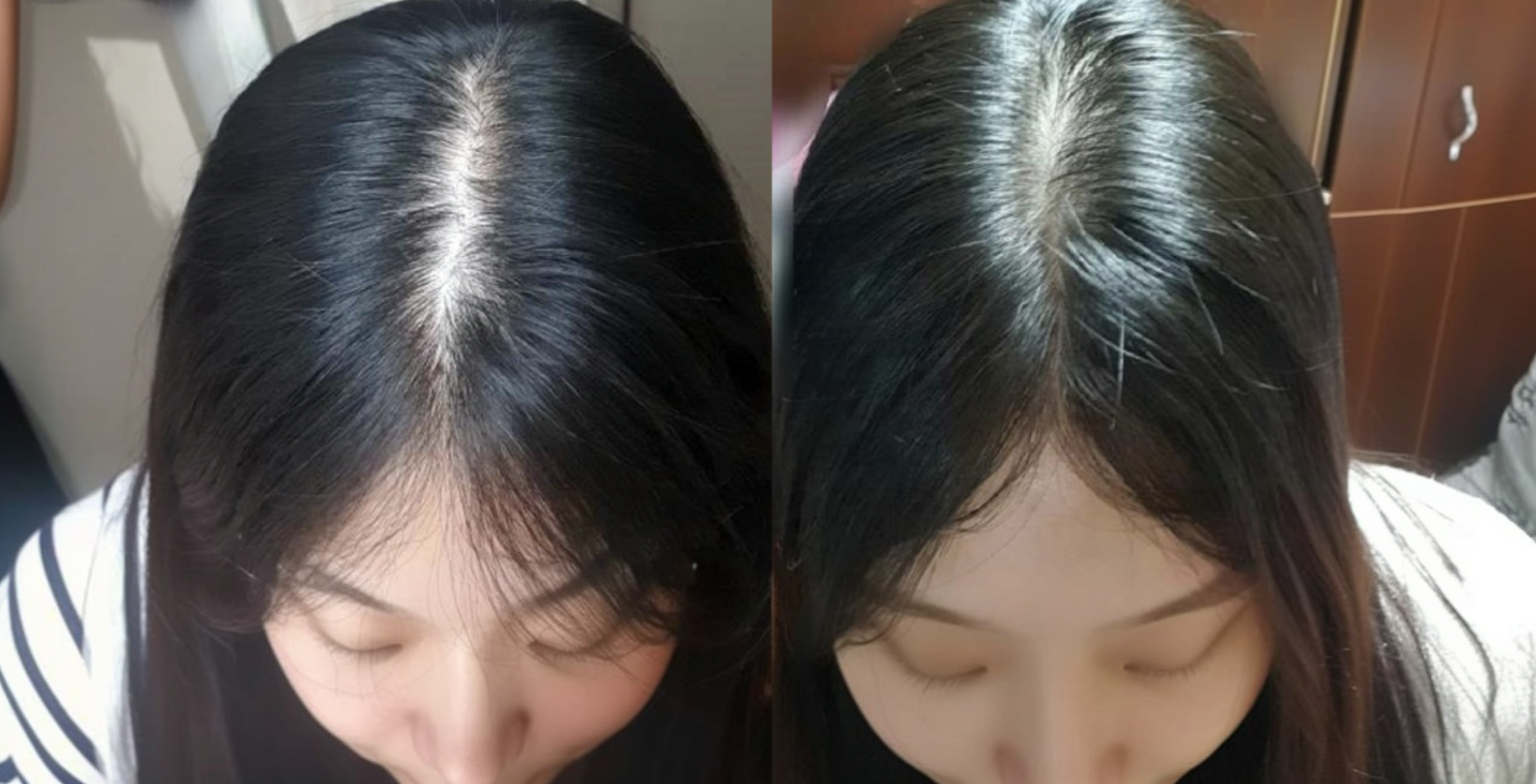 정수리 탈모 개선 사진