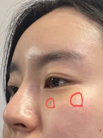 얼굴 비립종 없애는 법 자극 없이 제거하는 피부관리법_5