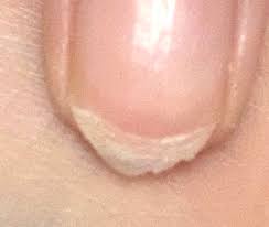 손톱이 잘 부러지는 이유